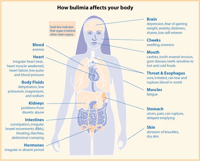 bulimiafaqdia